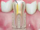 دستگاه استخراج ریشه دندان (Tooth Root Lifter)