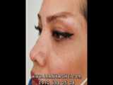 کاشت ابروی طبیعی- eyebrows transplant