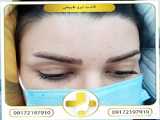 کاشت ابرو کاملا طبیعی