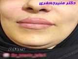 تزریق 8 سی سی ژل خنده