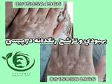 ویتیلیگو با درمان عااالی و گیاهی