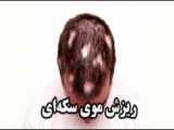 دکترزهراافراخته_ریزش موی سکه ای