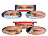 عمل جراحی فمتو لیزیک چشم توسط دکتر زهرا دست برهان