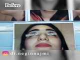 نمونه جراحی بینی بعد از 4ماه