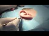قبل و  پس از جراحی زیبایی گوش توسط دکتر فیروزه ضیاء متخصص گوش و حلق و بینی