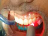 بلیچینگ دندان با لیزر توسط بهترین جراح لثه اصفهان