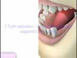 ساخت دندان مصنوعی (پروتز ایوبیس) برای افراد جوان   ضمانت نامه کتبی