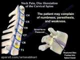 علائم و عوارض دیسک گردن - کوروش قاسم زاده فیزیوتراپی ایرانیان بابل