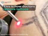 چه تاتو هایی با لیزر از بین می روند؟