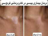 پیسی پوست خود را درمان کنید