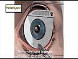عمل لیزیک چشم در تهران توسط دکتر شاهرخ میلان جراح و متخصص بیماریهای چشم