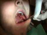 دکترآزاده خلجیان،چرا باید دندان عقل نهفته رو کشید،جراح دندانپزشک،تهران