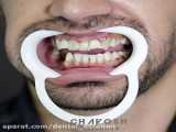 عمر ایمپلنت دندان چقدر است| بهترین ایمپلنت اصفهان