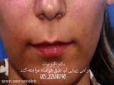 جراحی زیبایی بینی که بر اثر ضربه شکسته و تغییر فرم داده است.