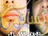 فیلم کامل کاشت مو در اتاق عمل