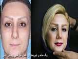 نتیجه جراحی بینی
