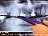 آموزش دستیاری رادیوگرافی او پی جی برای دستیاران دندانپزشکی