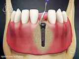 قرار دادن ۵ واحد ایمپلنت دندانی آمریکایی همراه با کشیدن و پیوند استخوان‌