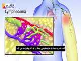 درمان لنف ادم را تا کی باید ادامه دهیم؟