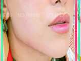 تزریق فیلرلب و زیر چشم