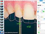 طراحی دیجیتال دندانپزشکی - بهترین دندانپزشکی زیبایی
