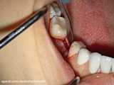 فیلم ایمپلنت؛ جراحی ایمپلنت دندان توسط دکتر میرشکار، متخصص ایمپلنت