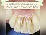 تفاوت جرم گیری دندان با سفید کردن،دکتر دامون امینی،کرج،باغستان