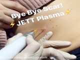 JETT PLASMA LIFT MEDICAL lower eyelids wrinkle smoothening