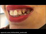 کامپوزیت ونیر دندان در کلینیک دندان پزشکی دکتر شیدا