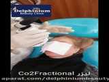 دستگاه لیزر  co2 fractional