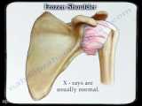 درمان شانه منجمد(یخ زده)