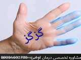 قطعی ترین درمان ام اس در مشهد