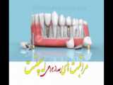 مراقبت های بعد از جراحی ایمپلنت توضیحات دندانپزشک دکتر شهریاری _مشهد