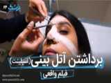 درمان خشکی داخل بینی بعد از عمل جراحی زیبایی بینی | دکتر فرشید آچاک