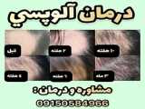 درمان پسوریازیس سر
