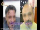 بعد از کاشت مو