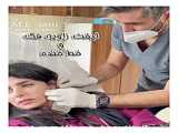انواع نخ های لیفت