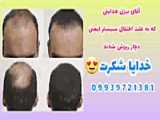 ریزش مو در بارداری