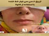 تزریق ژل خط خنده با تکنیک لایه به لایه در شیراز توسط دکتر مهسا پور هاشمی