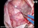 جراحی تومور مغزی مننژیوم بسیار بزرگ
