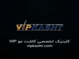 کاشت مو با جدیدترین متد روز دنیا-کلینیک vip