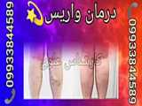نمونه درمان واریس