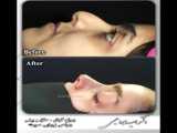 رفع افتادگی نوک بینی با جراحی زیبایی بینی توسط دکتر امید ابراهیمی