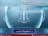 جراحی بینی کج در تهران