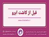 آیا لیفت بینی بدون جراحی امکان پذیر است | کاشت مو اصفهان