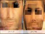 جراحی زیبایی بینی قبل و بعد عمل