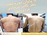 درمان پسوریازیس صورت
