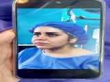 جراحی لیفت شقیقه و گونه