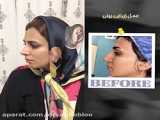 عمل زیبایی بینی (رفع انحراف بینی) - بهترین جراح بینی در تهران