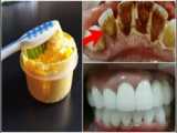 راهکار سفید کردن دندان ها - دندان های سفید عین مروارید